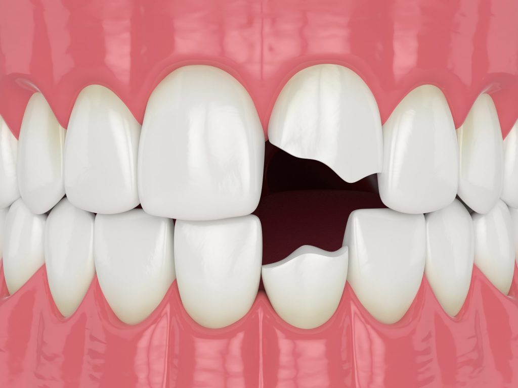 Chipped, Broken or Cracked Tooth Treatment