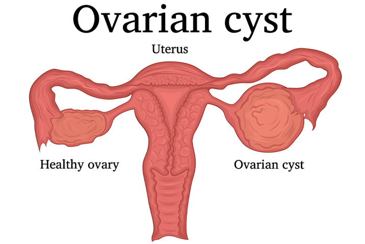 Ovarian Cyst Treatment