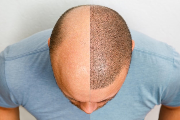 DHI Hair Transplantation
