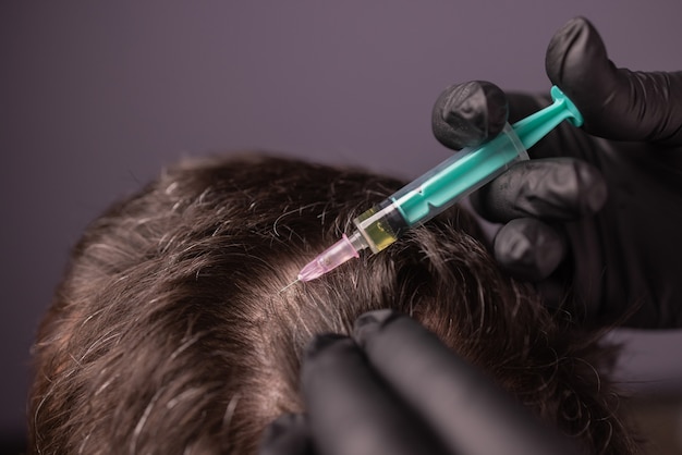 PRP (Platelet Rich Plasma) Hair Treatment