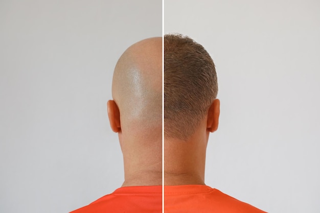 Sapphire FUE Hair Transplantation
