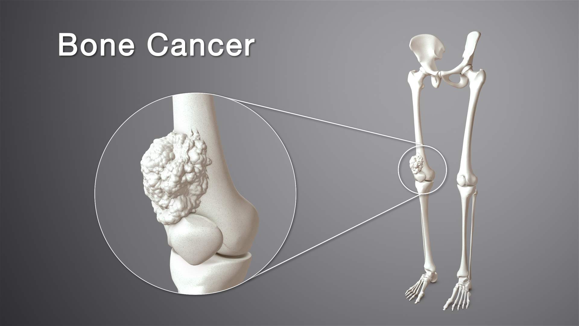 Diagnosis and Treatment of Bone Cancer