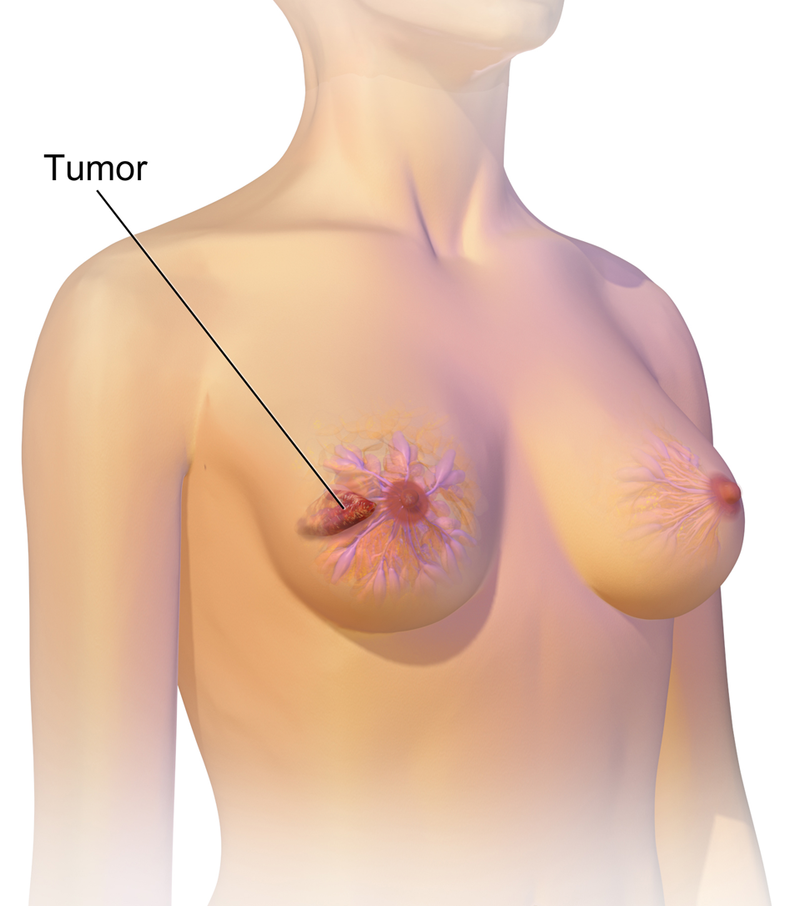 Diagnosis and Treatment of Breast Cancer