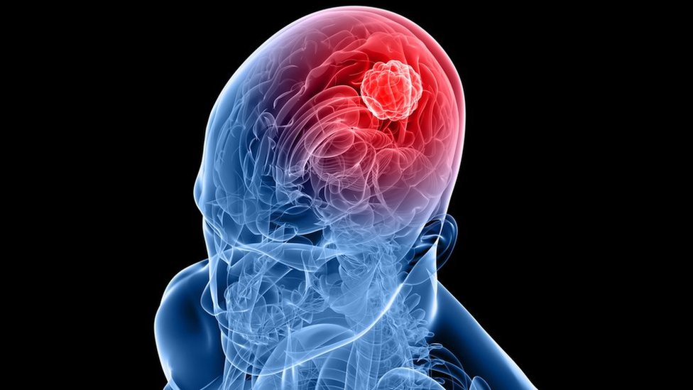 Glioblastoma (Beyin) Tümörü Tedavisi