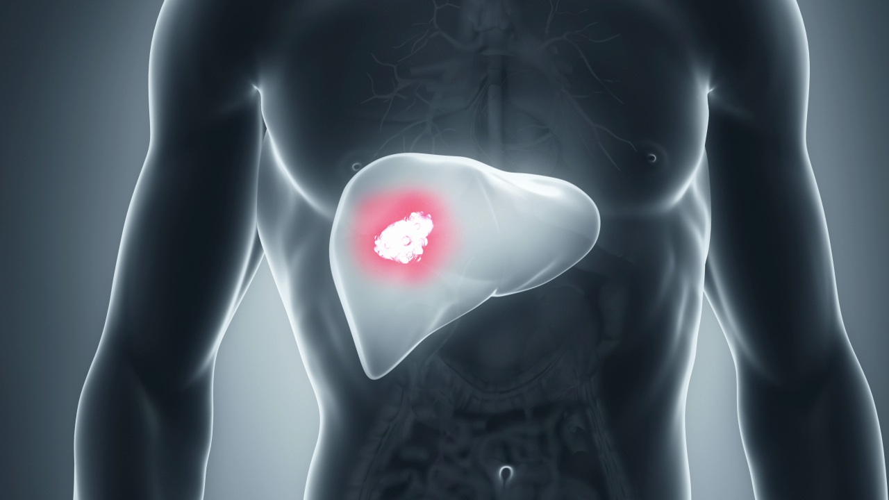 Diagnosis and Treatment of Liver Cancer