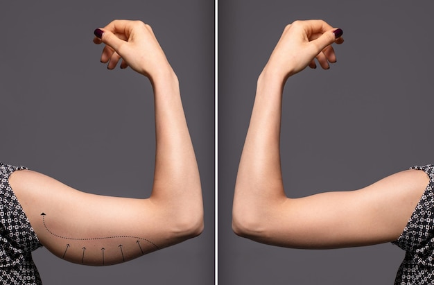 Lifting des bras (brachioplastie)