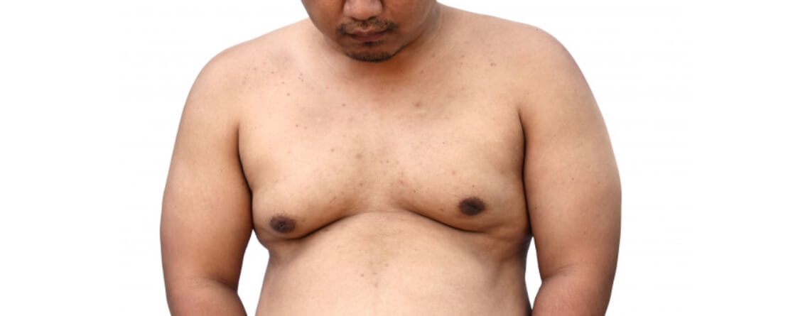 Gynecomastia Surgery
