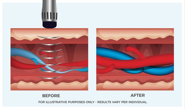 Extracorporeal Shockwave Therapy (ESWT)