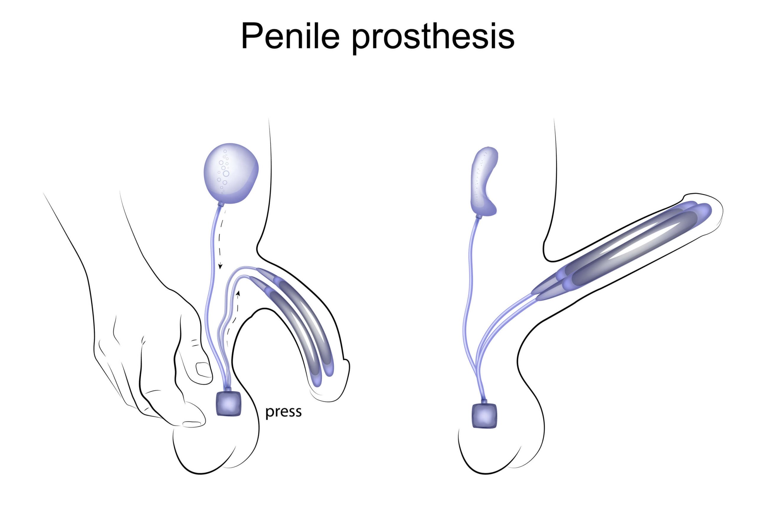 Penile Prosthesis Implantation