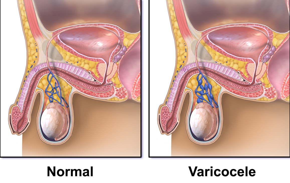 Varicocele (Infertility)